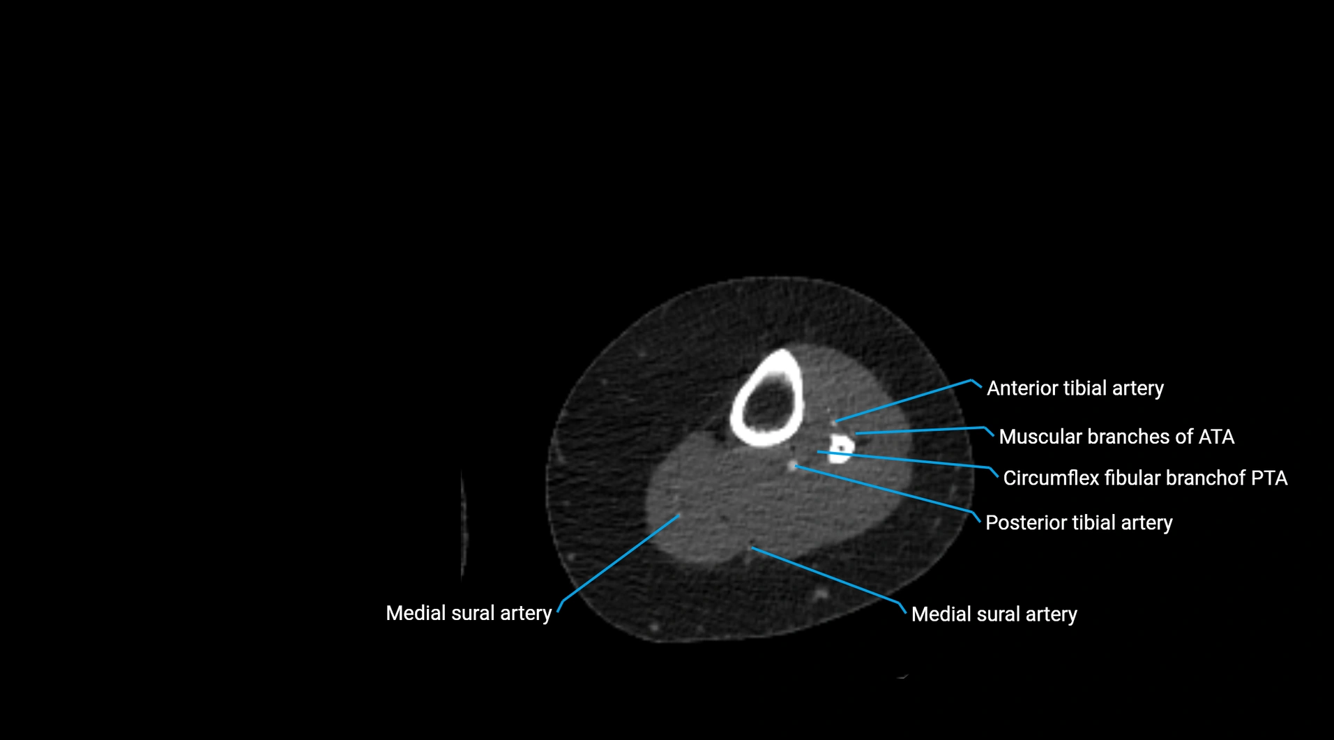 CTA lower limb cross sectional anatomy labelled image _197.webp